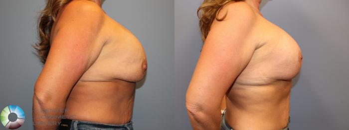 Before & After Breast Implant Revision Case 12064 Right Side in Denver and Colorado Springs, CO