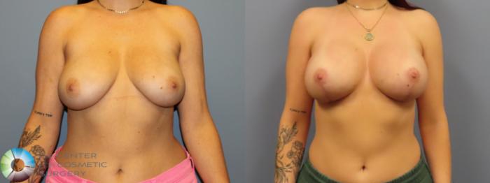 Before & After Breast Lift Case 12083 Front in Denver and Colorado Springs, CO