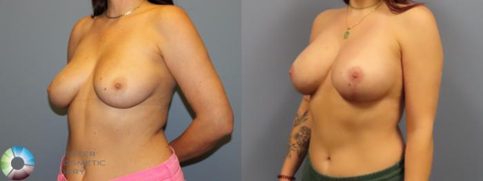 Before & After Breast Lift Case 12083 Left Oblique in Denver and Colorado Springs, CO