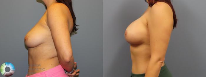 Before & After Breast Lift Case 12083 Left Side in Denver and Colorado Springs, CO