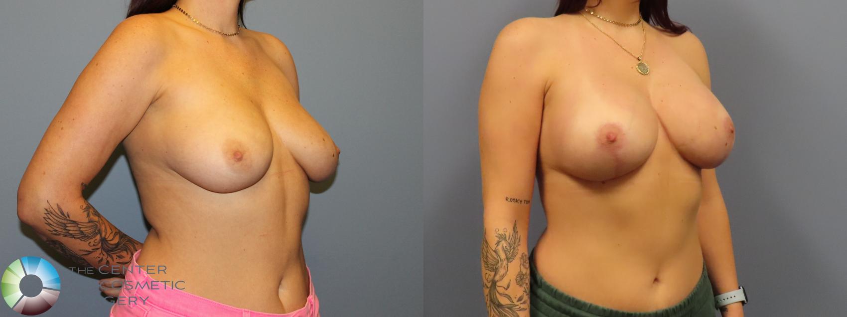 Before & After Breast Lift Case 12083 Right Oblique in Denver and Colorado Springs, CO