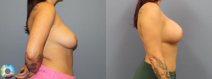 Before & After Breast Lift Case 12083 Right Side in Denver and Colorado Springs, CO