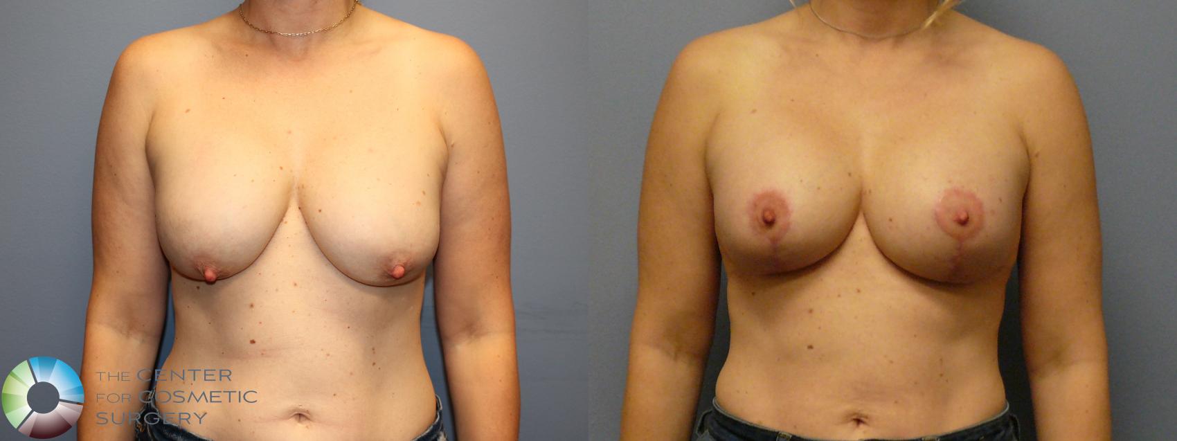 Before & After Breast Lift Case 12084 Front in Denver and Colorado Springs, CO