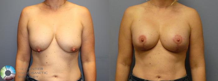 Before & After Breast Lift Case 12084 Front in Denver and Colorado Springs, CO