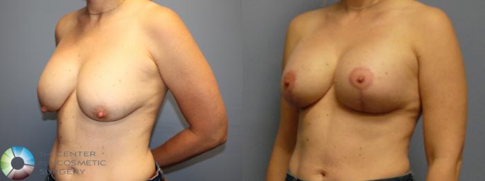 Before & After Breast Lift Case 12084 Left Oblique in Denver and Colorado Springs, CO