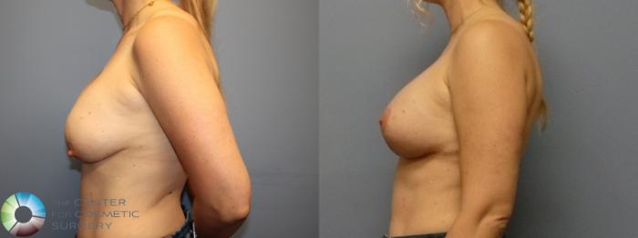 Before & After Breast Lift Case 12084 Left Side in Denver and Colorado Springs, CO