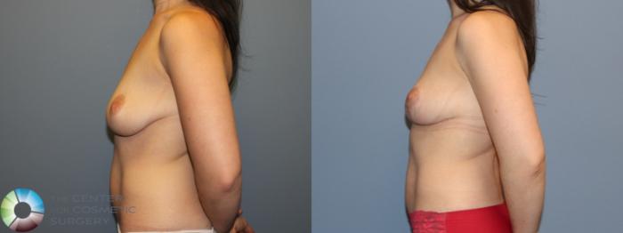 Before & After Breast Lift Case 12118 Left Side in Denver and Colorado Springs, CO