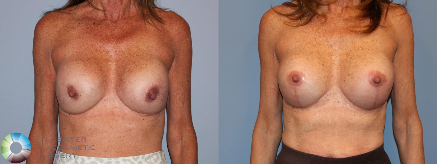 Before & After Breast Implant Revision Case 12120 Front in Denver and Colorado Springs, CO