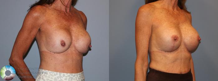 Before & After Breast Implant Revision Case 12120 Right Oblique in Denver and Colorado Springs, CO