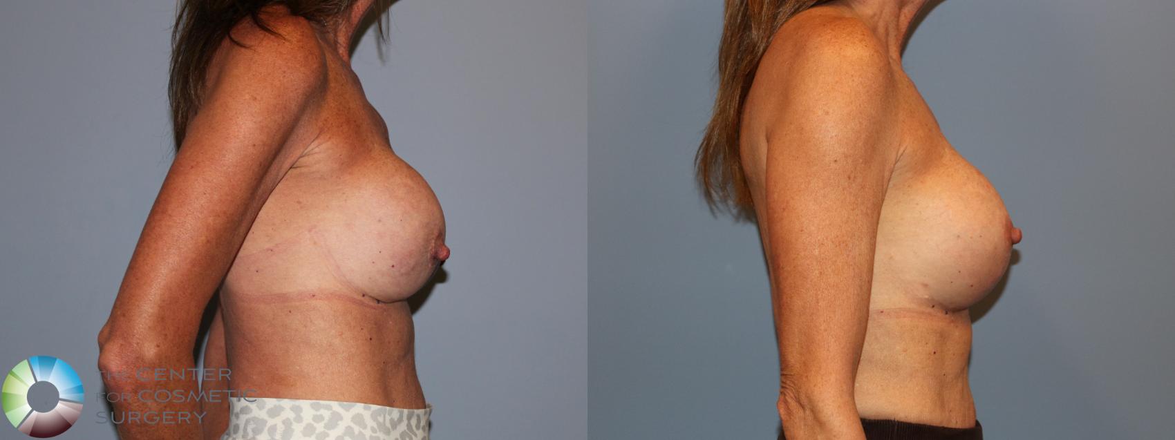 Before & After Breast Lift Case 12120 Right Side in Denver and Colorado Springs, CO