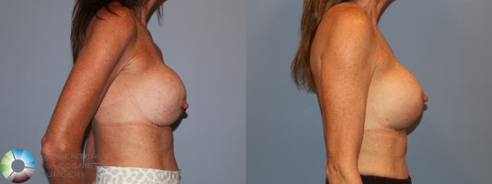 Before & After Breast Implant Revision Case 12120 Right Side in Denver and Colorado Springs, CO