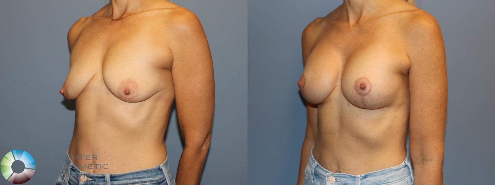 Before & After Breast Lift Case 12139 Left Oblique in Denver and Colorado Springs, CO