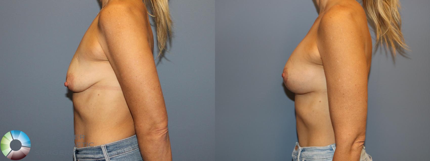 Before & After Breast Lift Case 12139 Left Side in Denver and Colorado Springs, CO