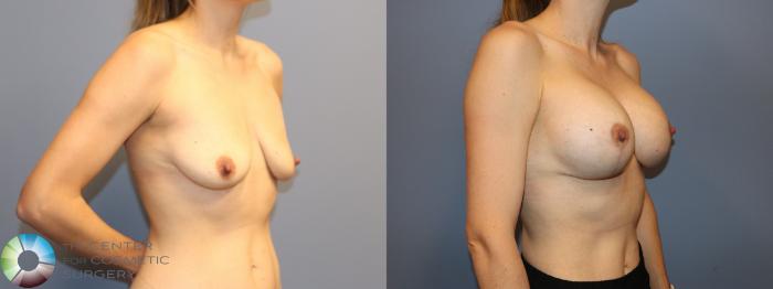 Before & After Breast Augmentation Case 12166 Right Oblique in Denver and Colorado Springs, CO