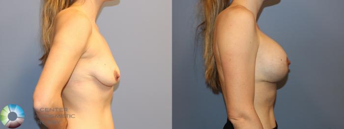 Before & After Breast Augmentation Case 12166 Right Side in Denver and Colorado Springs, CO