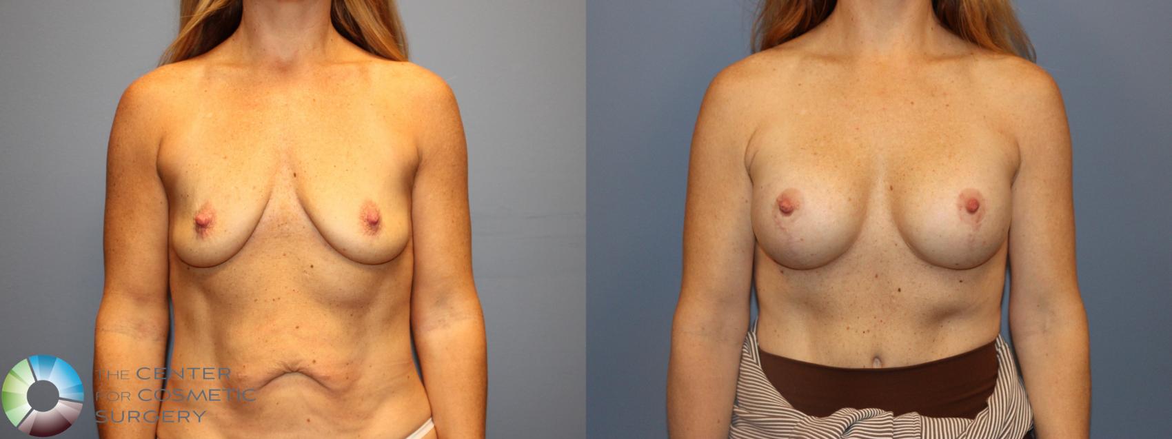 Before & After Breast Lift Case 12182 Front in Denver and Colorado Springs, CO