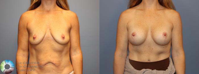 Before & After Breast Lift Case 12182 Front in Denver and Colorado Springs, CO