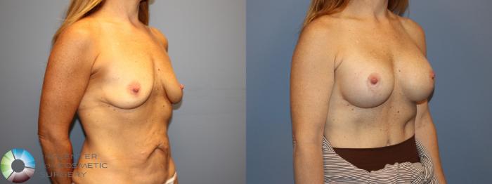 Before & After Breast Lift Case 12182 Right Oblique in Denver and Colorado Springs, CO