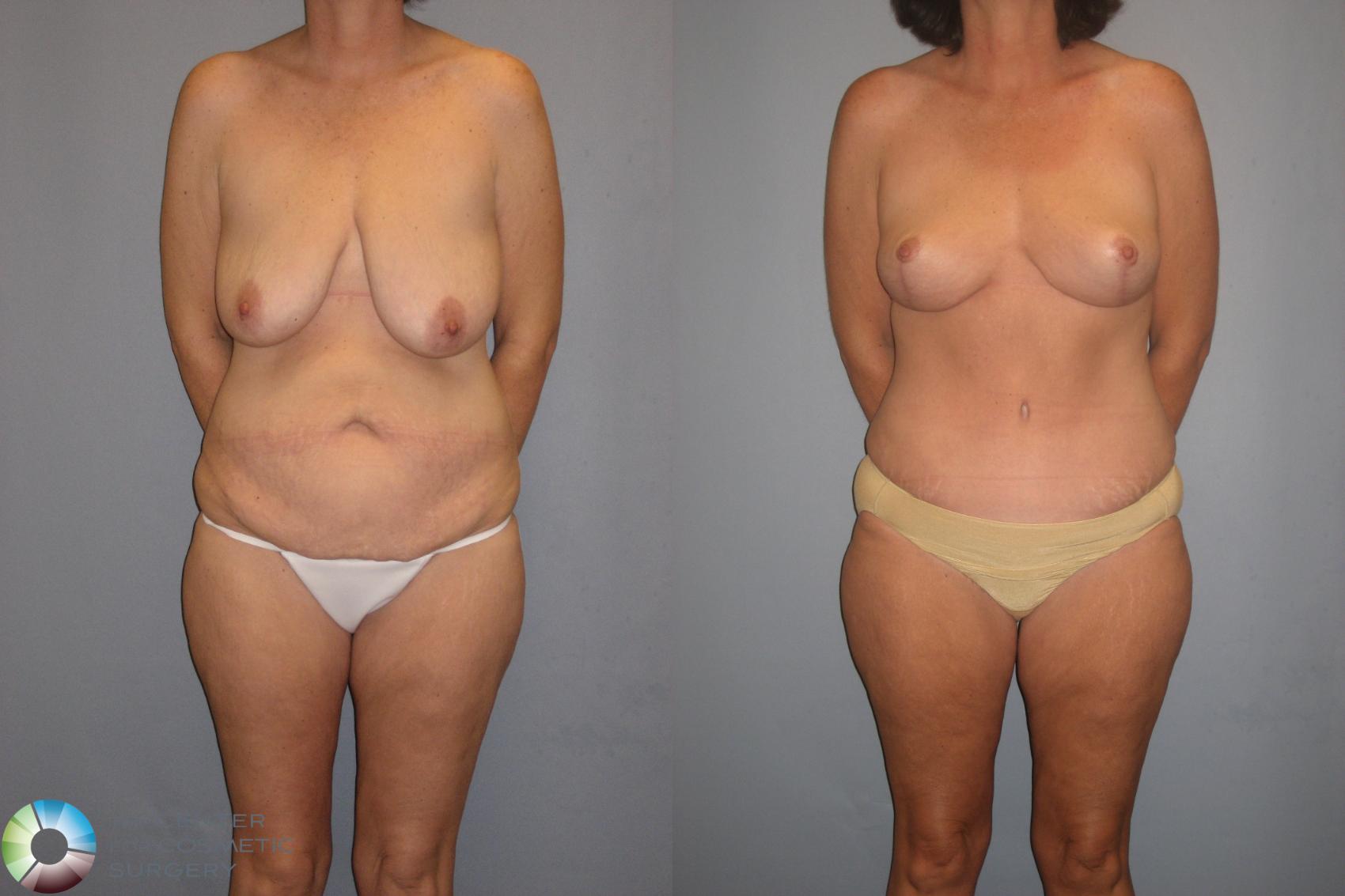 Before & After Tummy Tuck Case 141 View #1 in Denver and Colorado Springs, CO