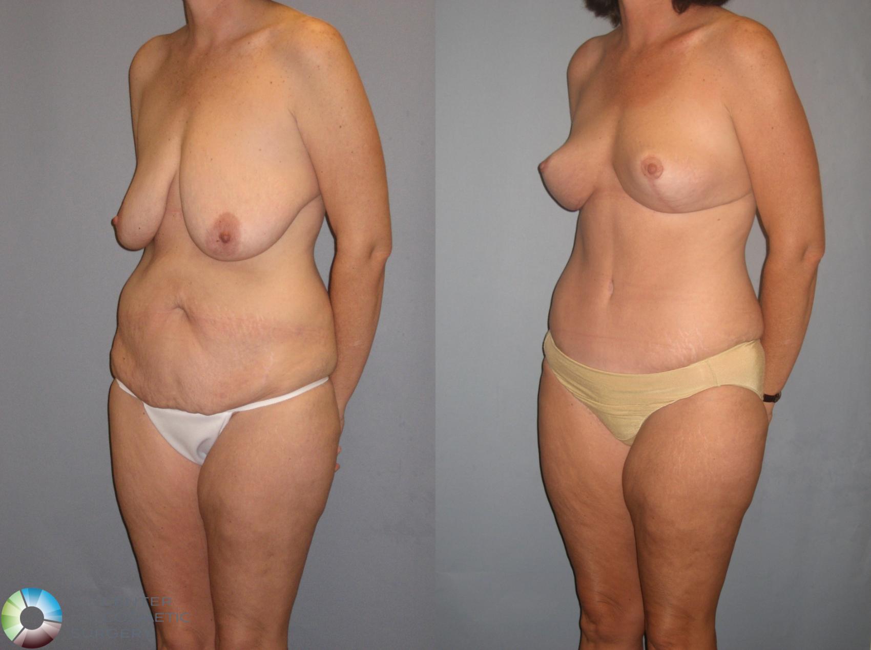 Before & After Breast Lift Case 141 View #2 in Denver and Colorado Springs, CO