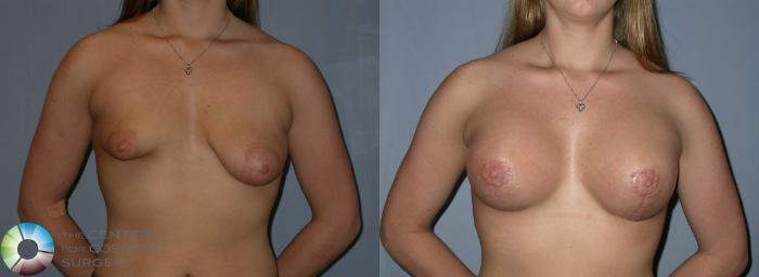 Before & After Breast Lift Case 181 View #1 View in Golden, CO
