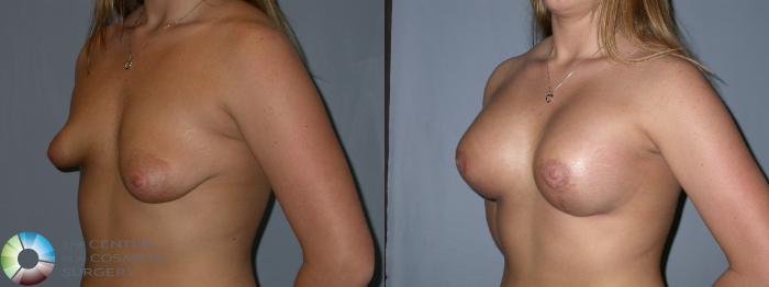 Before & After Breast Lift Case 181 View #2 View in Golden, CO