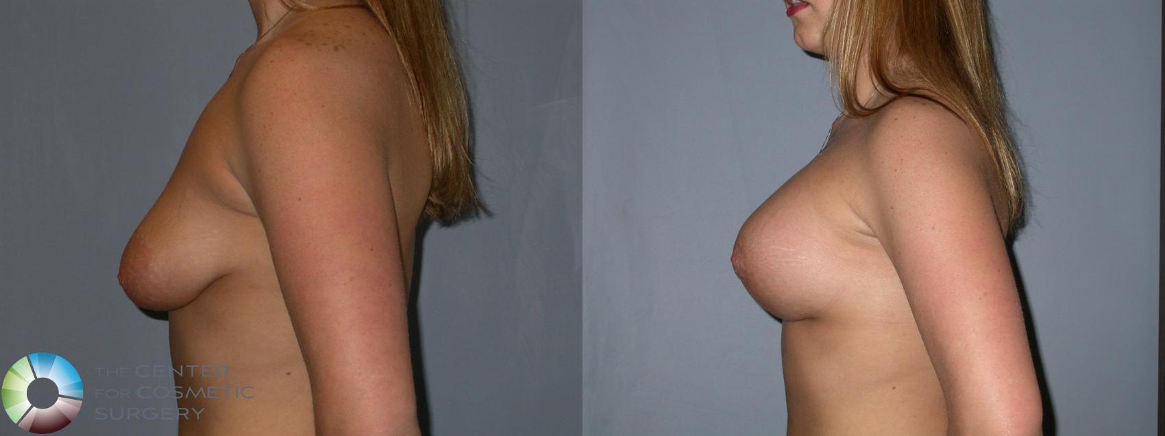Before & After Breast Lift Case 181 View #3 in Denver and Colorado Springs, CO
