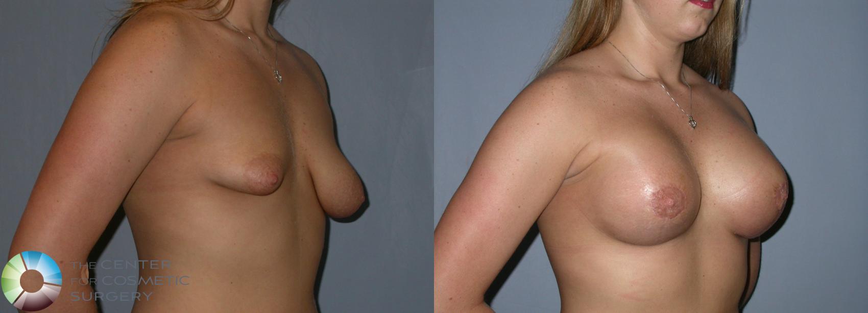 Before & After Breast Lift Case 181 View #4 in Denver and Colorado Springs, CO