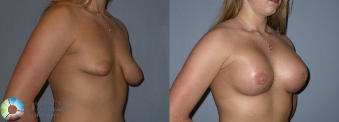 Before & After Breast Lift Case 181 View #4 View in Golden, CO