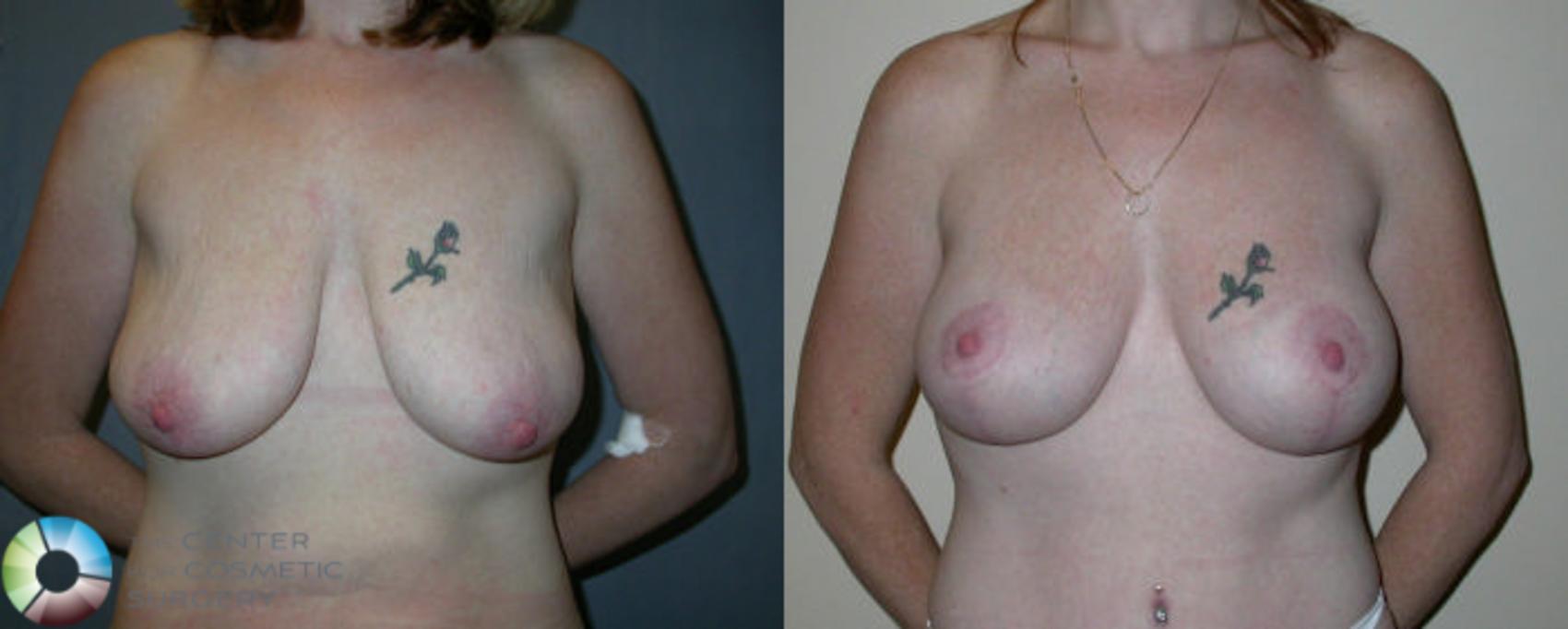 Before & After Breast Lift Case 21 View #1 in Denver and Colorado Springs, CO