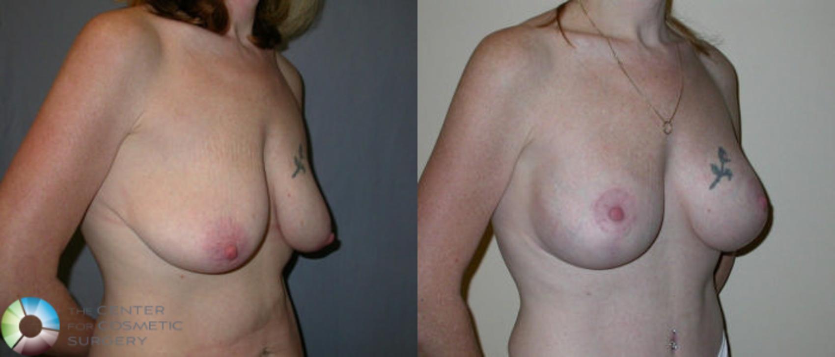 Before & After Breast Lift Case 21 View #2 View in Golden, CO