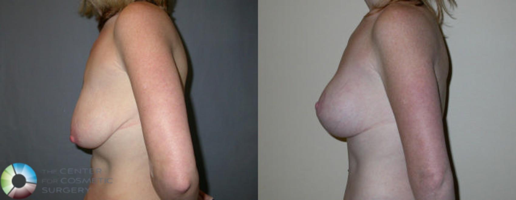 Before & After Breast Lift Case 21 View #3 View in Golden, CO