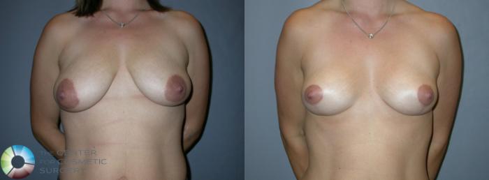 Before & After Breast Lift Case 214 View #1 View in Golden, CO