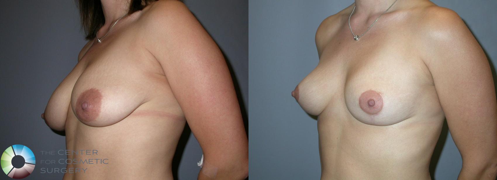 Before & After Breast Lift Case 214 View #2 in Denver and Colorado Springs, CO