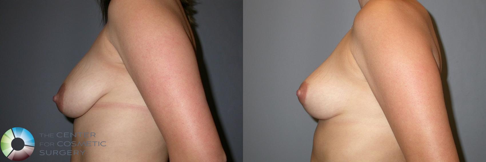 Before & After Breast Lift Case 214 View #3 in Denver and Colorado Springs, CO