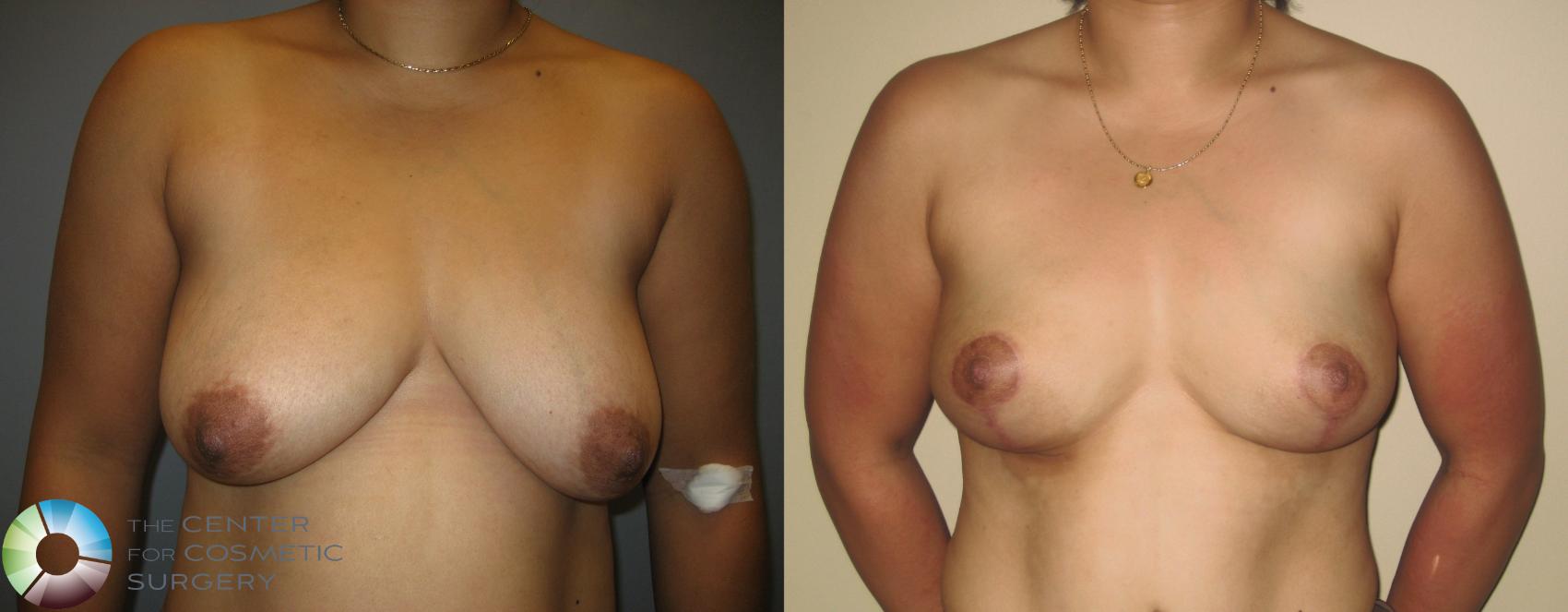 Before & After Breast Lift Case 221 View #1 in Denver and Colorado Springs, CO