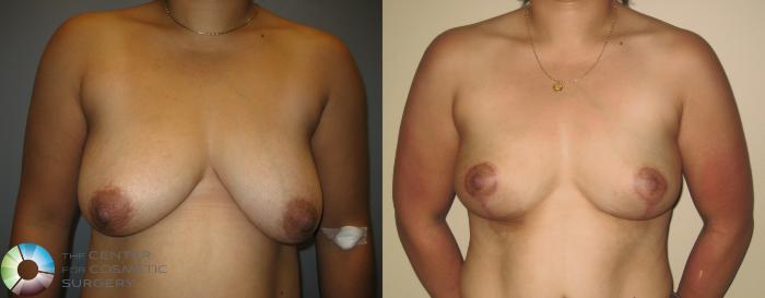 Before & After Breast Lift Case 221 View #1 View in Golden, CO