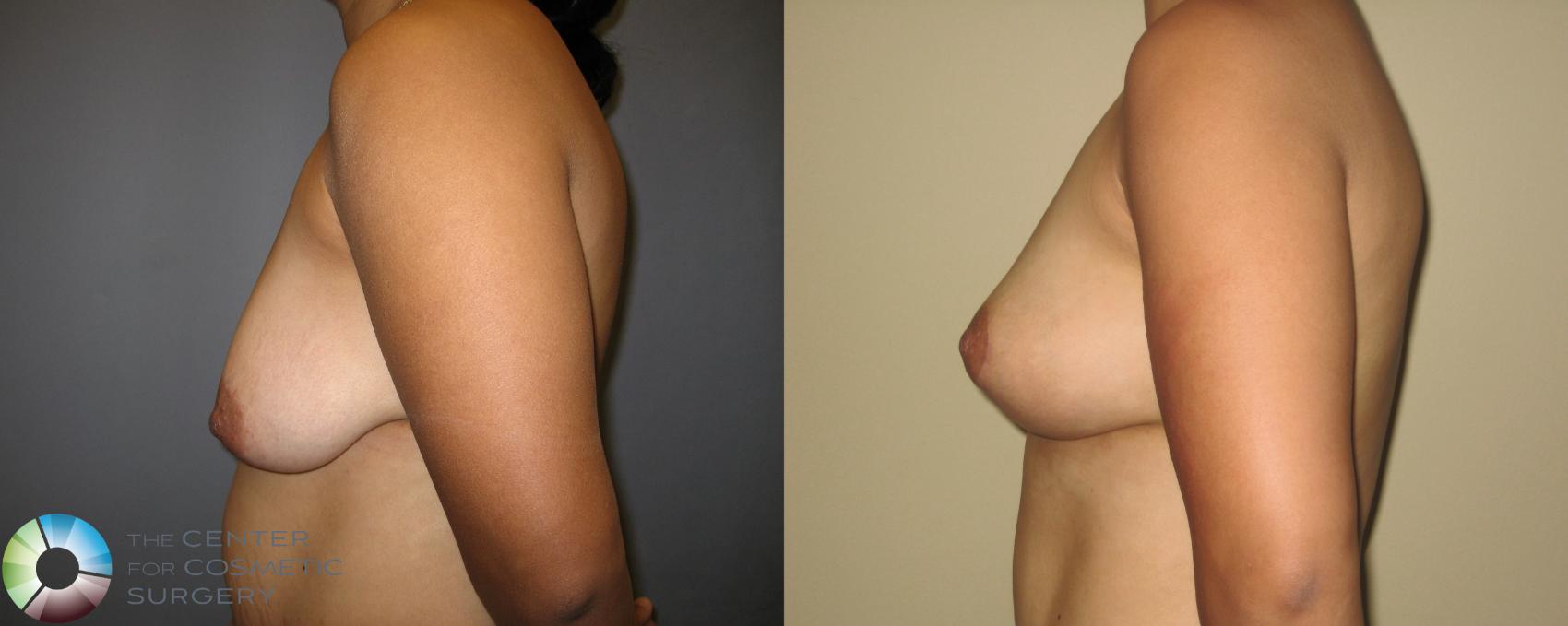 Before & After Breast Lift Case 221 View #2 View in Golden, CO