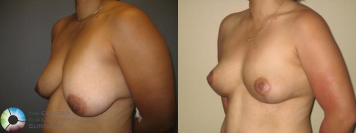 Before & After Breast Lift Case 221 View #3 View in Golden, CO