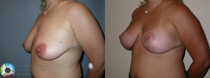 Before & After Breast Lift Case 23 View #1 View in Golden, CO