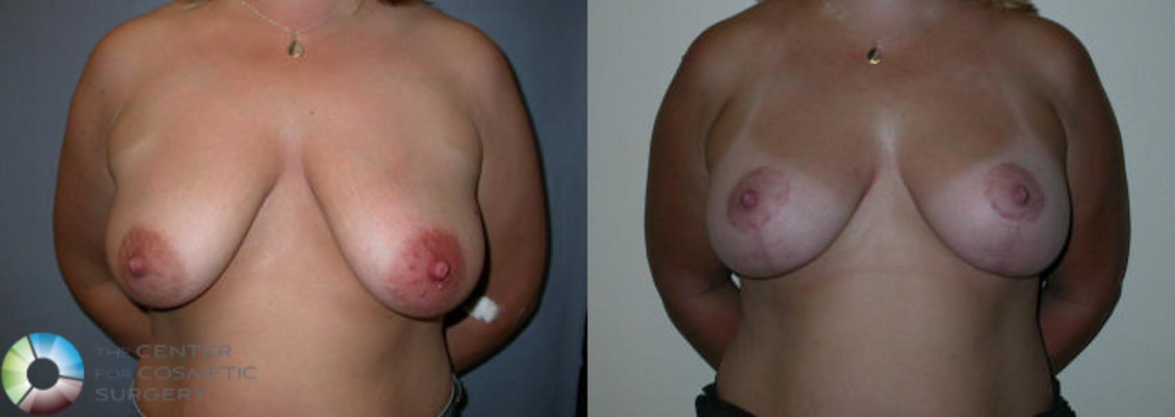 Before & After Breast Lift Case 23 View #2 in Denver and Colorado Springs, CO