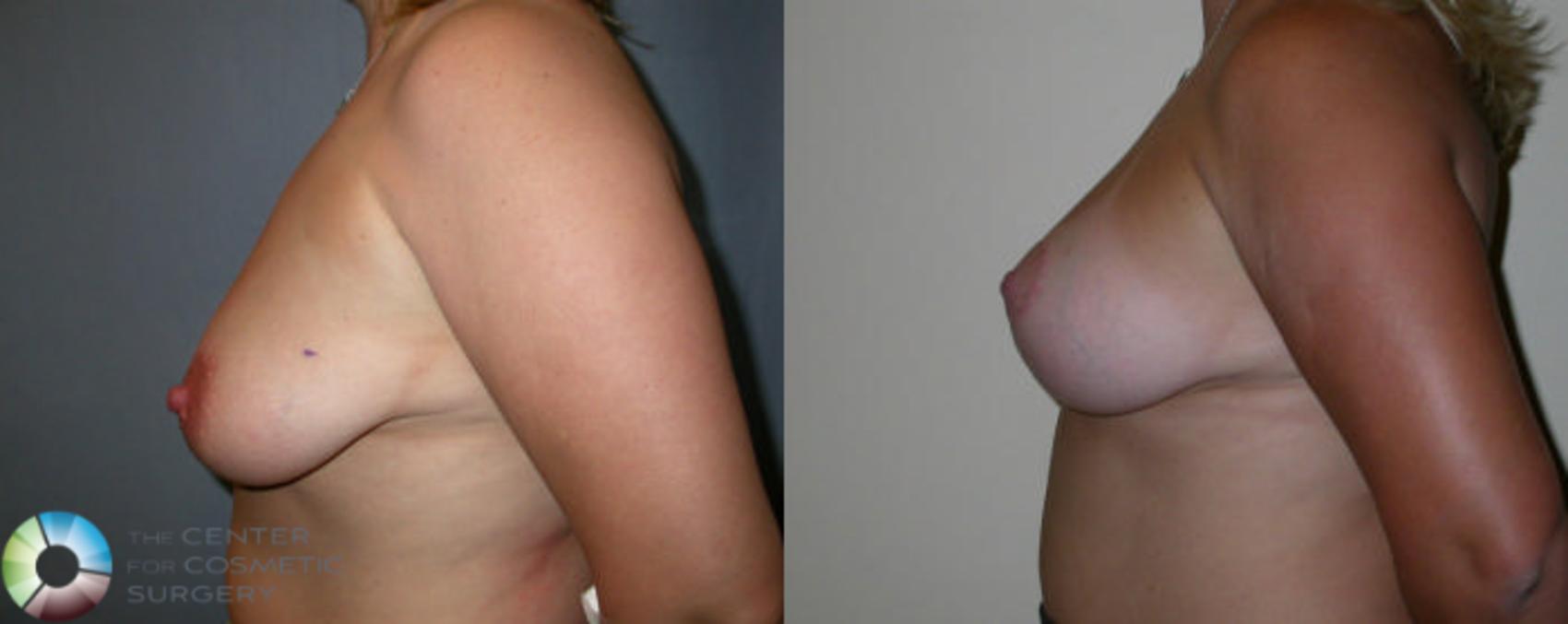 Before & After Breast Lift Case 23 View #3 in Denver and Colorado Springs, CO
