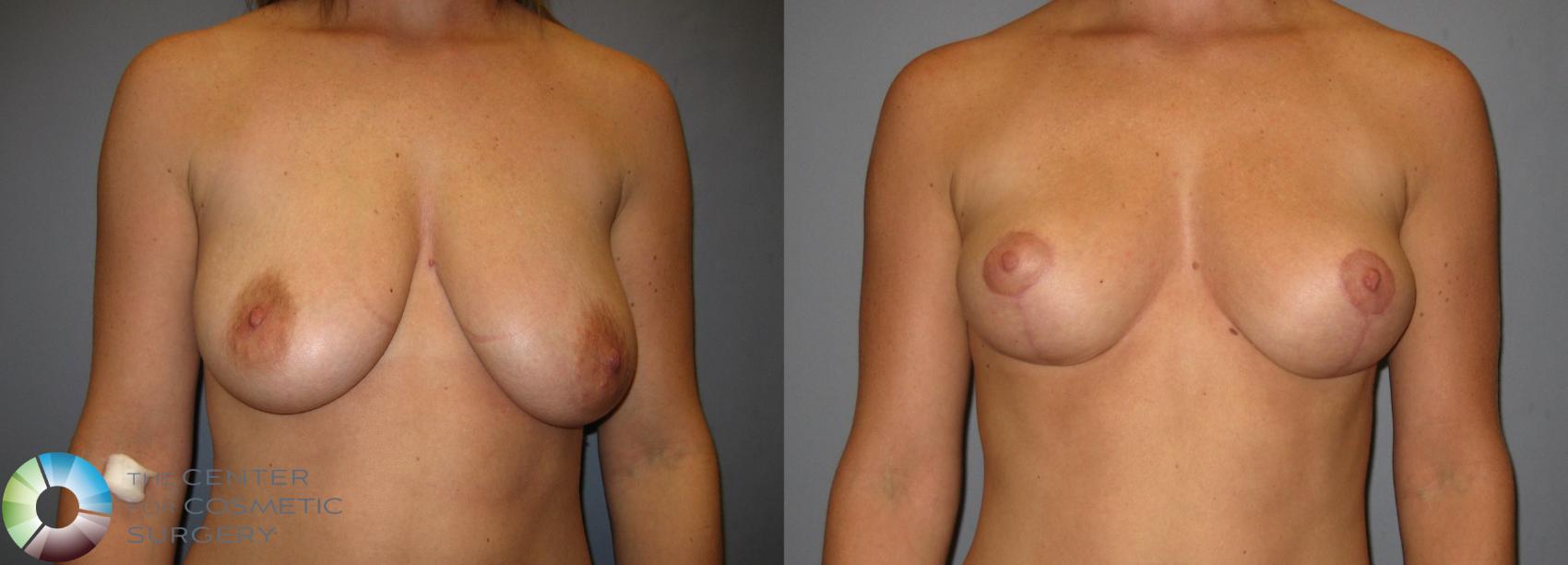 Before & After Breast Lift Case 238 View #1 in Denver and Colorado Springs, CO