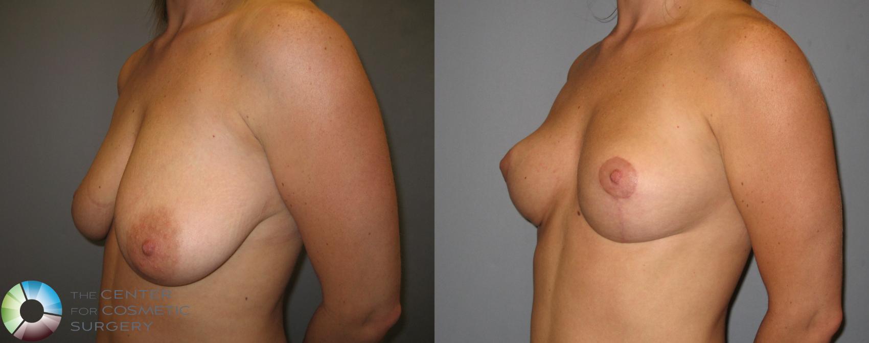 Before & After Breast Lift Case 238 View #2 View in Golden, CO