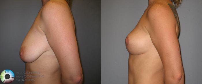 Before & After Breast Lift Case 238 View #3 View in Golden, CO