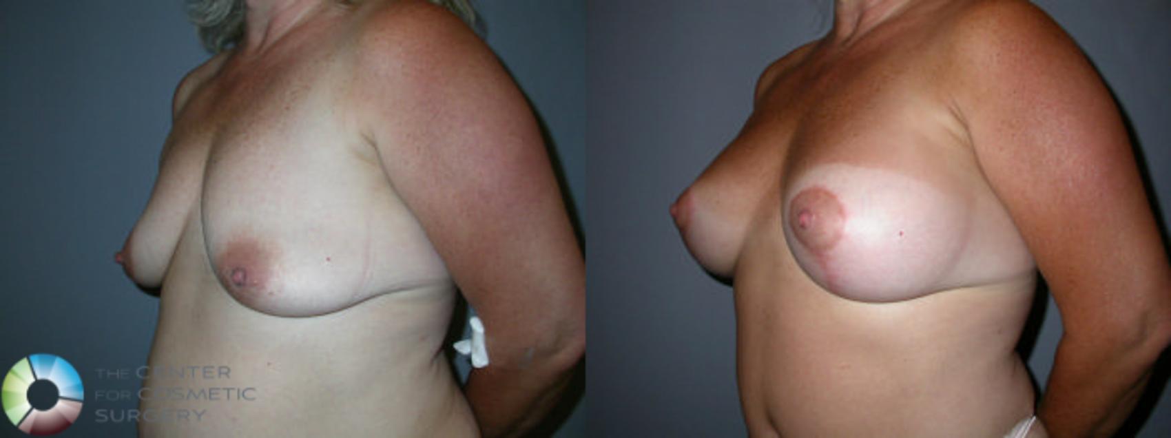 Before & After Breast Lift Case 34 View #1 View in Golden, CO