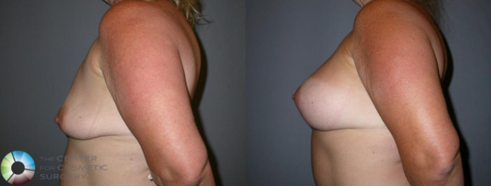 Before & After Breast Lift Case 34 View #2 in Denver and Colorado Springs, CO