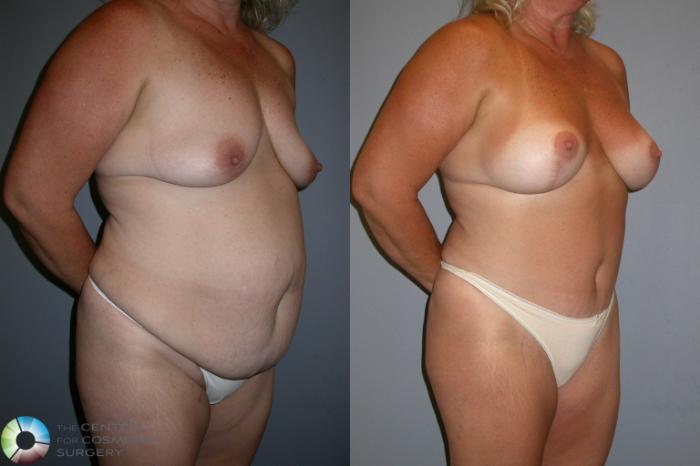 Before & After Breast Lift Case 34 View #3 View in Golden, CO