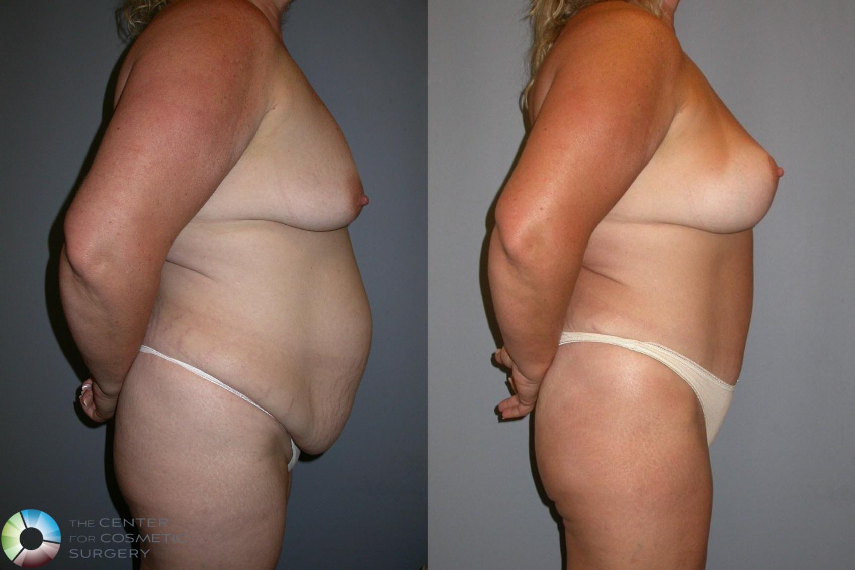 Before & After Breast Lift Case 34 View #5 View in Golden, CO