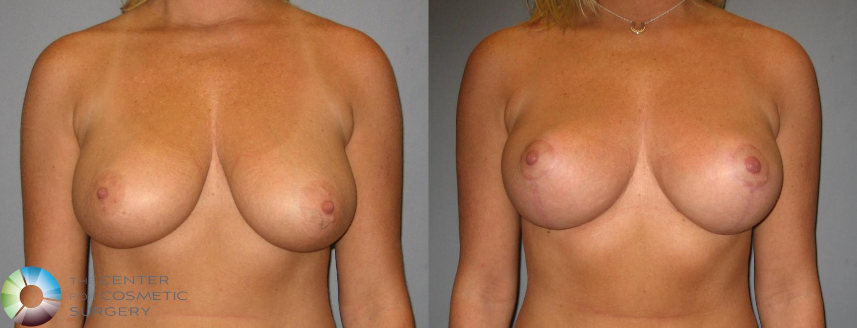 Before & After Breast Lift Case 356 View #1 in Denver and Colorado Springs, CO